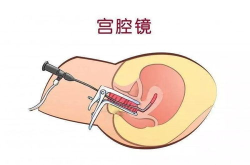 宫腔镜手术是怎么做的,微创治疗女性妇科疾病的革命性技术